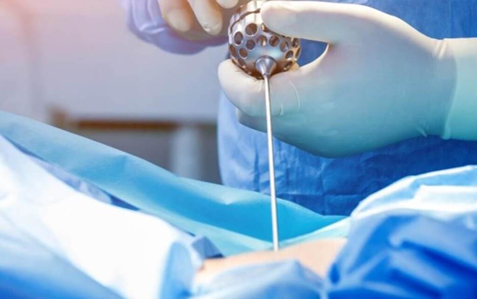 What Is PECD Uniportal Surgery and Why It’s Changing Spinal Treatment - tuyauplusturf - tuyauplus - tuyauplus turf