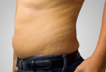 Understanding the Different Types of Stretch Marks
