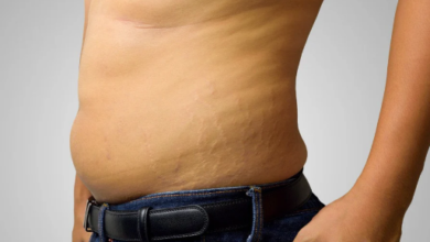 Understanding the Different Types of Stretch Marks