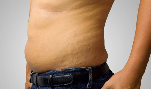 Understanding the Different Types of Stretch Marks